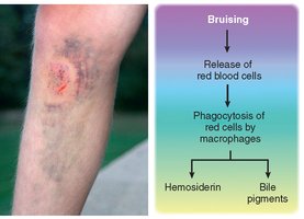 Bruising: photo and diagram of breakdown of blood pigments
