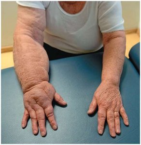 Edema in the arm due to lymphatic dysfunction