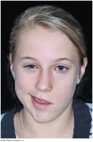 Bell's palsy clinical presentation