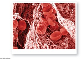 Structure of a blood clot with trapped RBCs and fibrin network