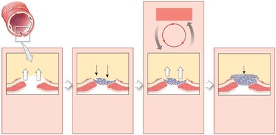 Positive feedback: blood clotting