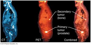 CT and PET Scan for Prostate Cancer