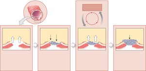 Positive feedback: blood clotting