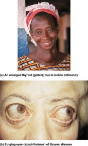 Clinical manifestations: goiter and Graves' disease
