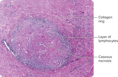 Histological section of tubercle with caseous necrosis