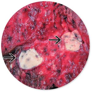 Gross pathology of tuberculous lung with caseous lesions