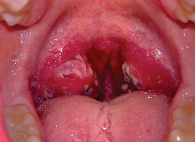 Reddened and swollen pharynx with exudate, typical of bacterial pharyngitis