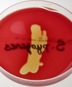 Beta-hemolysis of Streptococcus pyogenes on blood agar