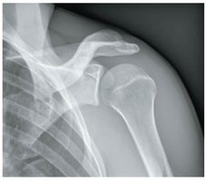 X-ray showing epiphyseal line