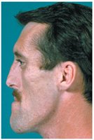 Example of acromegaly