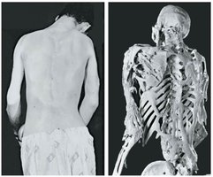 Example of fibrodysplasia ossificans progressiva