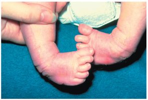 Example of congenital talipes equinovarus (clubfoot)