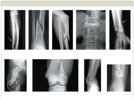Types of fractures