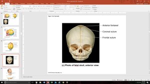 Anterior view of fetal skull with fontanelles and sutures