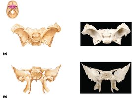 Sphenoid bone features and foramina