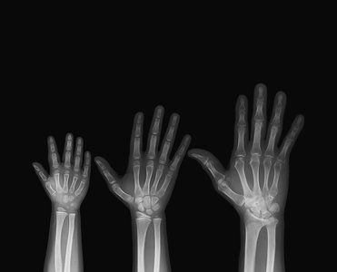 Epiphyseal plate and line in bone