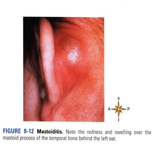Mastoiditis showing redness and swelling behind the ear