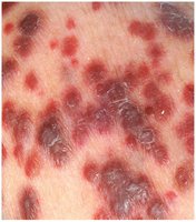 Kaposi’s sarcoma in AIDS patient