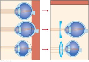 Bringing things into focus: emmetropic, myopic, and hyperopic eyes