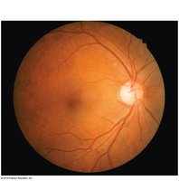 Fundus of the retina as seen with an ophthalmoscope