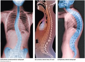 Examples of abnormal spinal curvatures