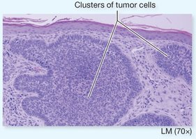 Clusters of tumor cells in carcinoma