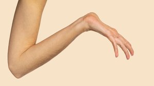 Marfan syndrome: hyperextensible joints