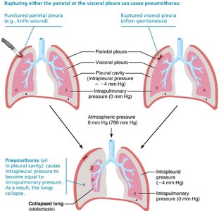 Pneumothorax