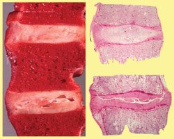 Healthy and degenerated intervertebral discs
