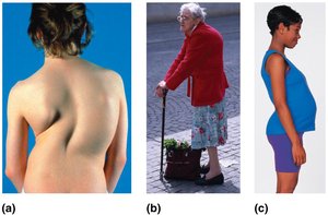 Examples of scoliosis, kyphosis, and lordosis