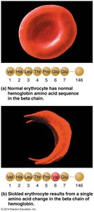 Normal vs sickled erythrocyte and hemoglobin sequence