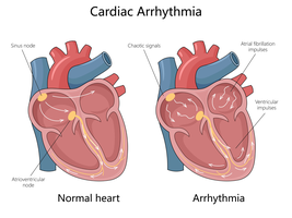Diagram comparing normal heart conduction and arrhythmia
