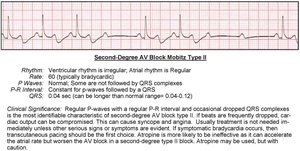 Second-degree AV block Mobitz II EKG strip