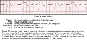 Third-degree AV block EKG strip
