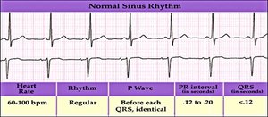 Normal sinus rhythm EKG strip with table of features