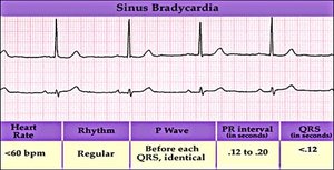 Sinus bradycardia EKG strip with table of features