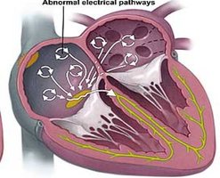 Diagram of abnormal atrial electrical pathways in atrial fibrillation