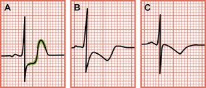 EKG showing ST segment changes in MI