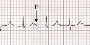 Diagram of AV block conduction