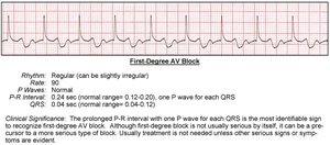 First-degree AV block EKG strip