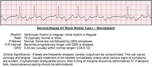 Second-degree AV block Mobitz I EKG strip