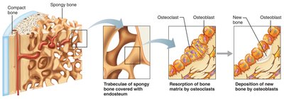 Remodeling of spongy bone
