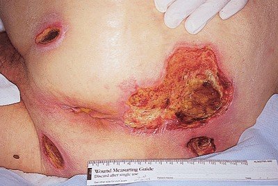 Bedsores (decubitus ulcers) on skin