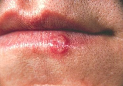 Herpes simplex infection on lips