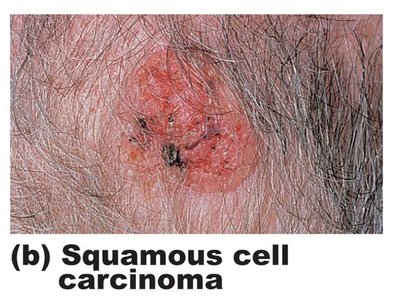 Squamous cell carcinoma on skin