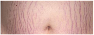 Stretch marks on the skin