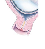 Uterus and placenta after fetal removal