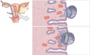 Blastocyst embedding into the endometrium