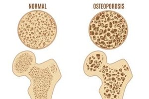 Normal vs. osteoporotic bone