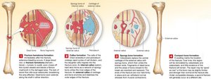 Stages of bone fracture healing